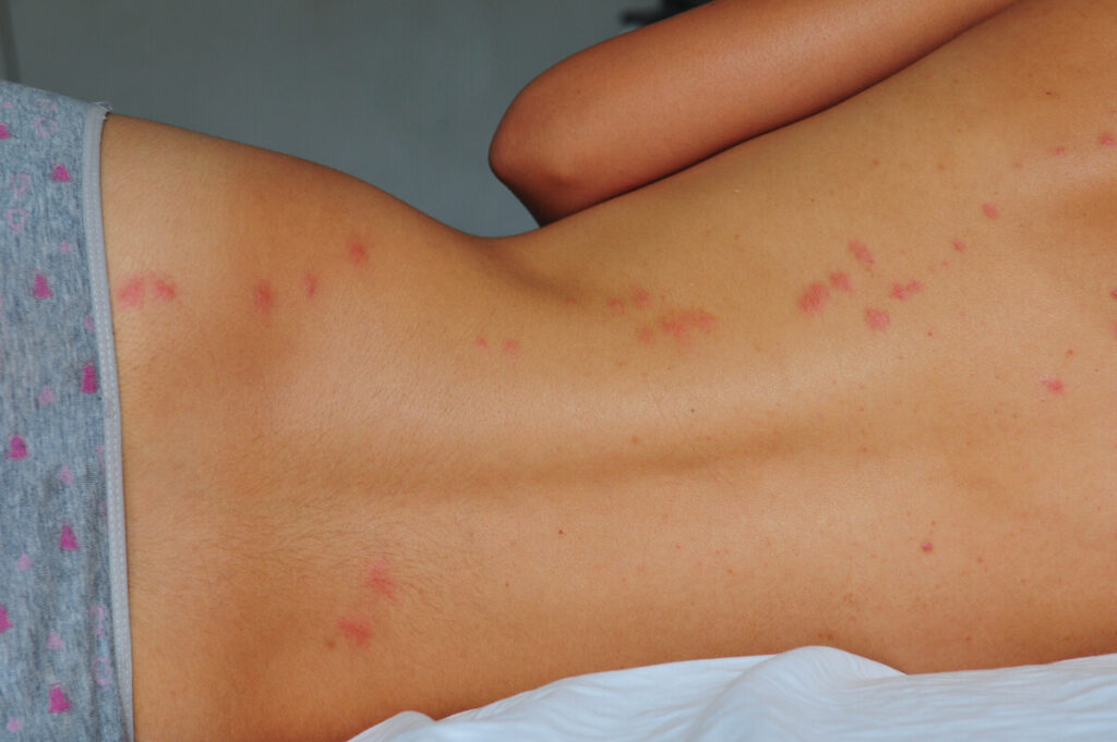 Two-day old lines of bedbug bites on a woman's back